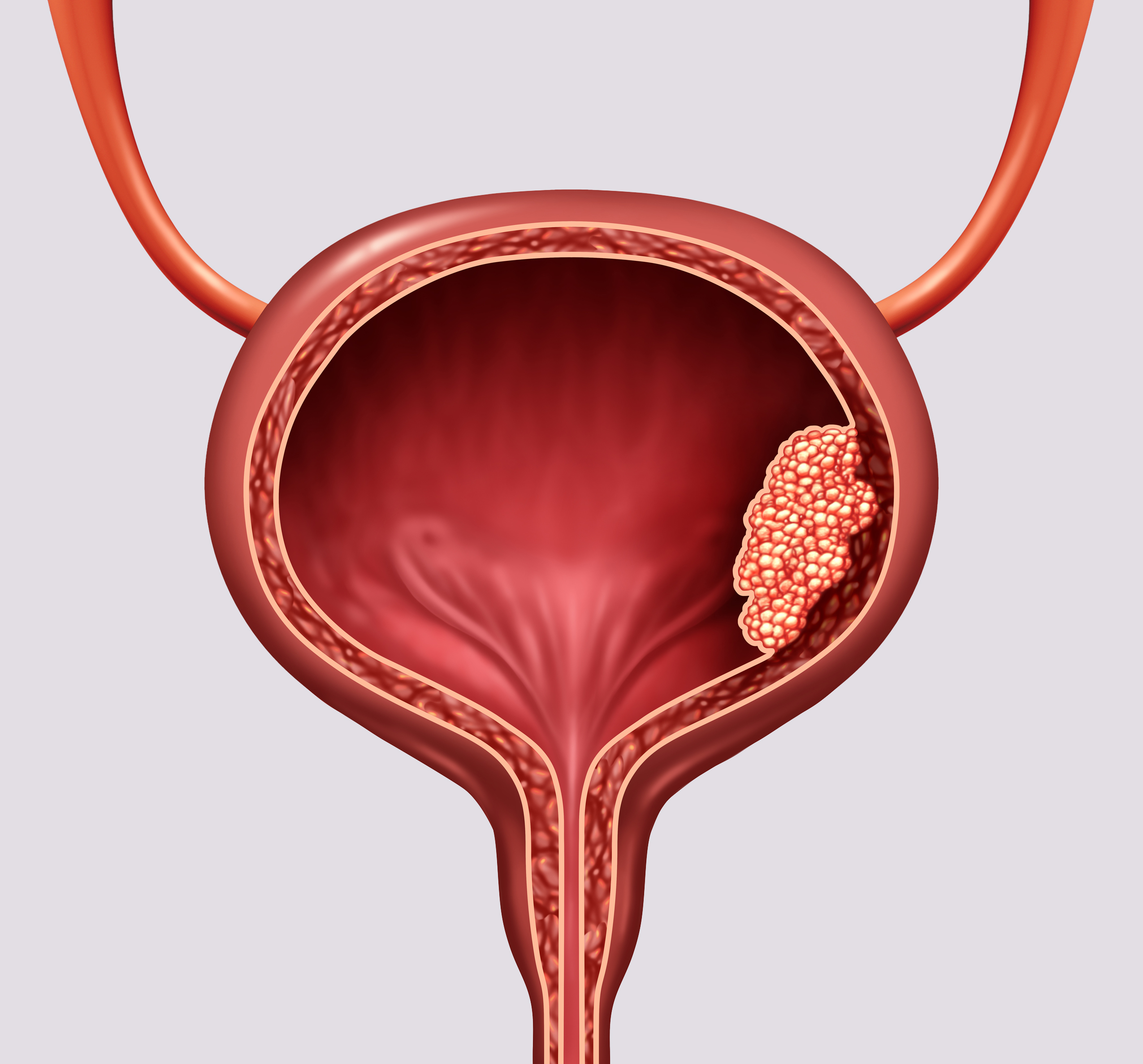 Human bladder cancer as a urinary anatomical organ disease and malignant cells concept as a 3D illustration cutaway of body anatomy.