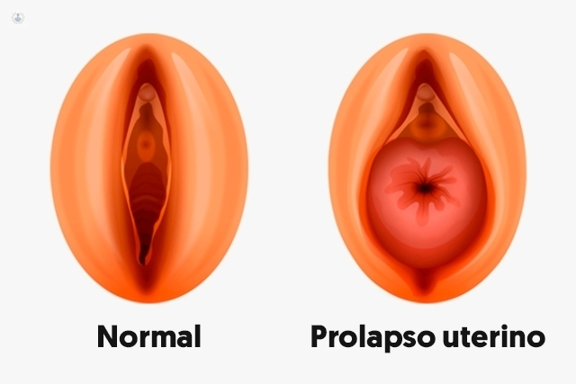 https://wilderinturias.com/wp-content/uploads/2023/01/prolapso-uterito.png